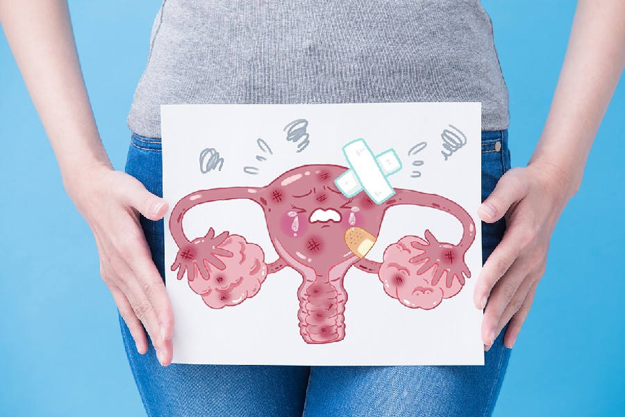 Syndrome des Ovaires Polykystiques (SOPK) et fertilité