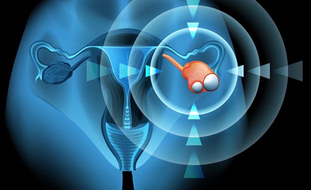 Syndrome des ovaires polykystiques : vers un nouveau traitement pour le soigner