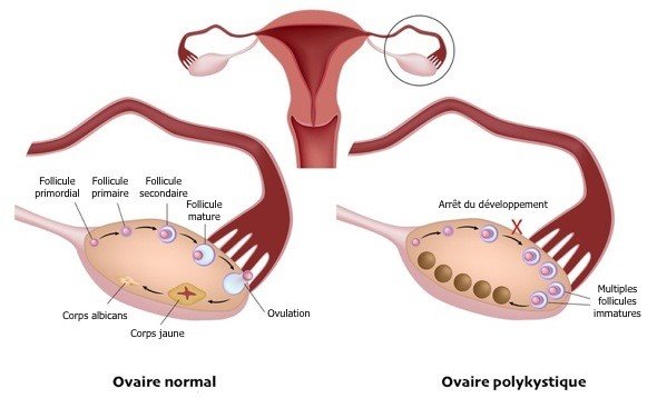 Zoom sur le syndrome des ovaires polykystiques.